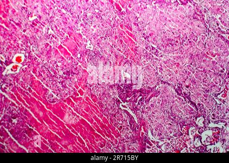 Miliary tuberculosis, light micrograph, photo under microscope Stock Photo