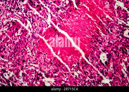 Miliary tuberculosis, light micrograph, photo under microscope Stock Photo