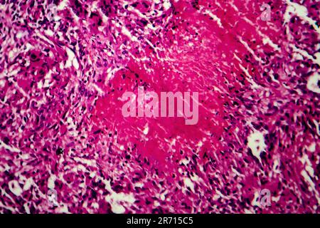 Miliary tuberculosis, light micrograph, photo under microscope Stock Photo