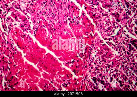 Miliary tuberculosis, light micrograph, photo under microscope Stock Photo