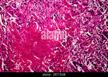 Miliary tuberculosis, light micrograph, photo under microscope Stock Photo