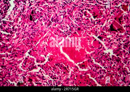 Miliary tuberculosis, light micrograph, photo under microscope Stock Photo