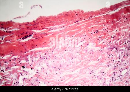 Histopathology of tuberculous pleurisy, light micrograph, photo under microscope Stock Photo