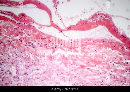 Histopathology of tuberculous pleurisy, light micrograph, photo under microscope Stock Photo