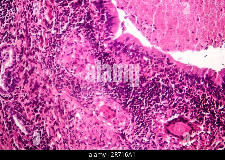 Caseous pneumonia, light micrograph, photo under microscope. Tuberculosis pneumonia Stock Photo