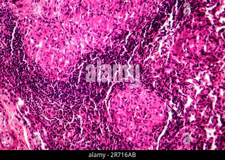 Caseous pneumonia, light micrograph, photo under microscope. Tuberculosis pneumonia Stock Photo