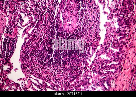 Caseous pneumonia, light micrograph, photo under microscope. Tuberculosis pneumonia Stock Photo