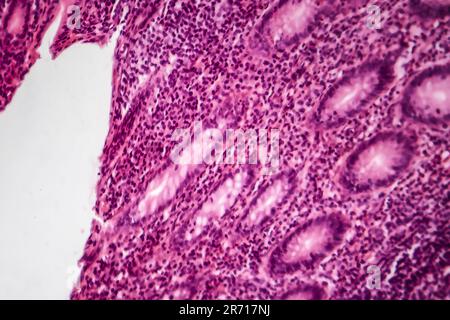 Acute simple appendicitis, light micrograph, photo under microscope Stock Photo