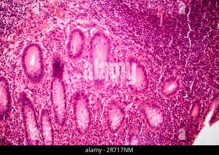 Acute simple appendicitis, light micrograph, photo under microscope Stock Photo