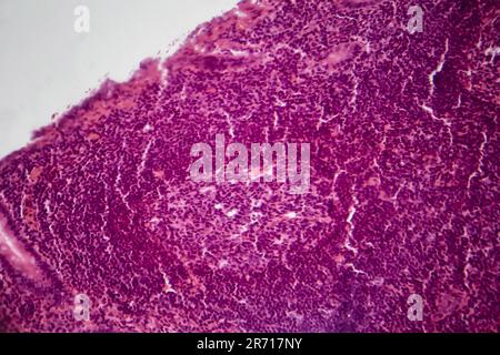 Acute simple appendicitis, light micrograph, photo under microscope Stock Photo