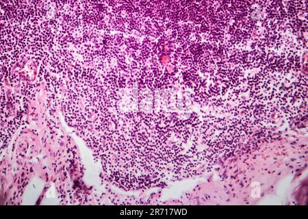 Acute simple appendicitis, light micrograph, photo under microscope Stock Photo