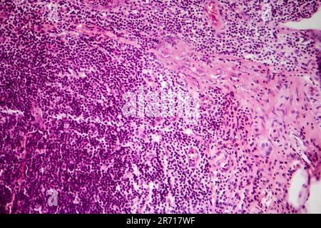 Acute simple appendicitis, light micrograph, photo under microscope Stock Photo