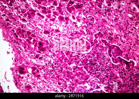 Histopathology of subacute severe hepatitis, light micrograph, photo ...