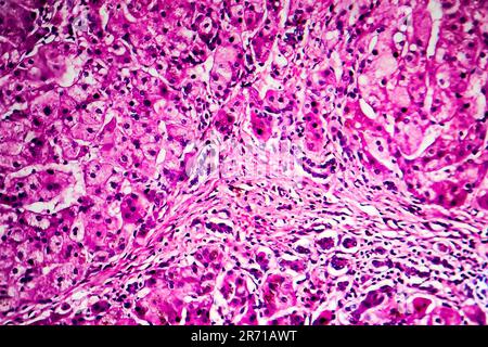 Histopathology of biliary liver cirrhosis, light micrograph, photo ...