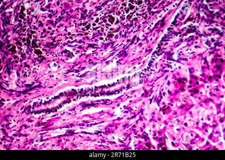 Histopathology of biliary liver cirrhosis, light micrograph, photo ...