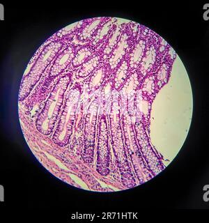 Bacillary dysentery, light micrograph, photo under microscope showing presence of bacteria and accumulation of inflammatory cells in intestinal epithe Stock Photo