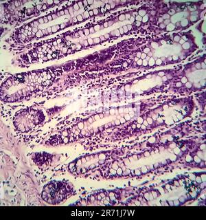 Bacillary dysentery, light micrograph, photo under microscope showing presence of bacteria and accumulation of inflammatory cells in intestinal epithe Stock Photo