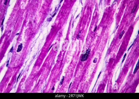 Histopathology of heart hypertrophy, high magnification. Photomicrograph showing hypertrophic myocardium with thick muscle fibers and enlarged and dar Stock Photo