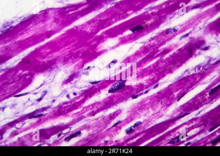 Histopathology of heart hypertrophy, high magnification. Photomicrograph showing hypertrophic myocardium with thick muscle fibers and enlarged and dar Stock Photo