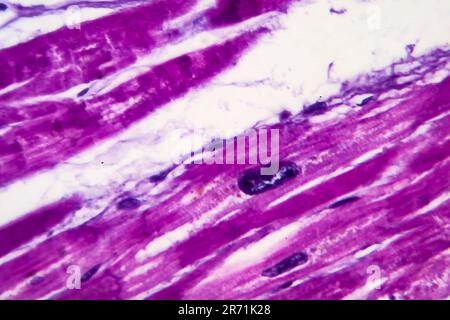 Histopathology of heart hypertrophy, high magnification. Photomicrograph showing hypertrophic myocardium with thick muscle fibers and enlarged and dar Stock Photo