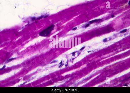 Histopathology of heart hypertrophy, high magnification. Photomicrograph showing hypertrophic myocardium with thick muscle fibers and enlarged and dar Stock Photo