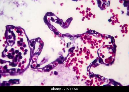 Histopathology of smoker's lung. Light micrograph showing accumulation of carbon particles in lung tissue Stock Photo