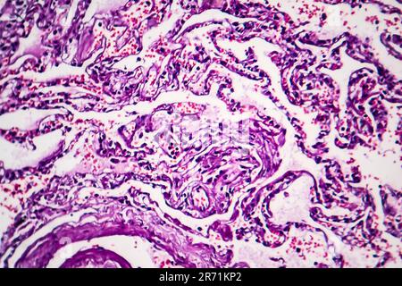 Histopathology of smoker's lung. Light micrograph showing accumulation of carbon particles in lung tissue Stock Photo