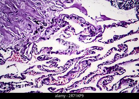 Histopathology of smoker's lung. Light micrograph showing accumulation of carbon particles in lung tissue Stock Photo