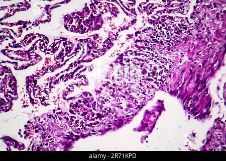 Histopathology of smoker's lung. Light micrograph showing accumulation of carbon particles in lung tissue Stock Photo