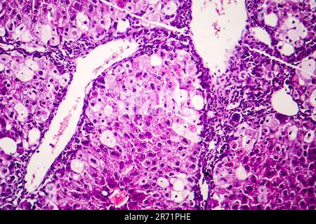 Histopathology of acute hepatitis, light micrograph, photo under ...