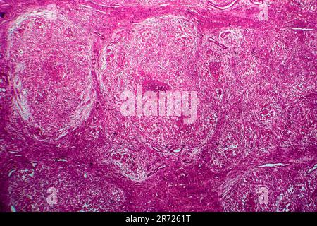 Renal tuberculosis, light micrograph, photo under microscope Stock Photo