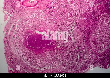 Renal tuberculosis, light micrograph, photo under microscope Stock Photo