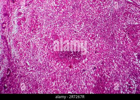 Renal tuberculosis, light micrograph, photo under microscope Stock Photo