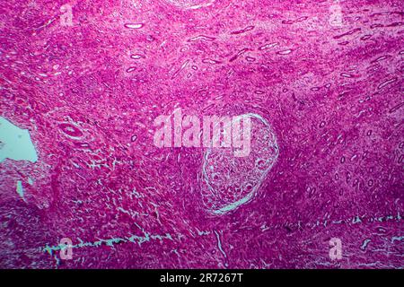 Renal tuberculosis, light micrograph, photo under microscope Stock Photo