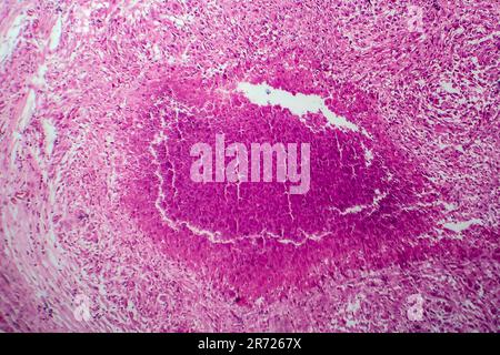 Renal tuberculosis, light micrograph, photo under microscope Stock Photo