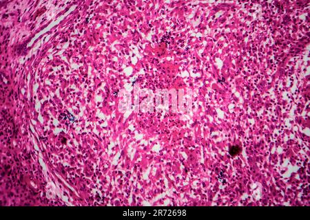 Renal tuberculosis, light micrograph, photo under microscope Stock Photo