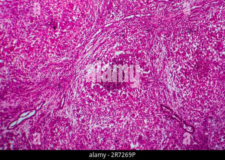 Renal tuberculosis, light micrograph, photo under microscope Stock Photo