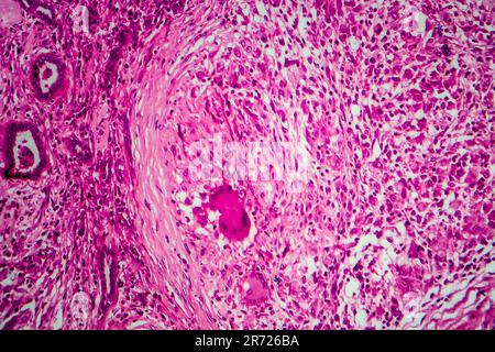 Renal tuberculosis, light micrograph, photo under microscope Stock Photo