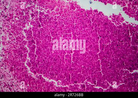 Renal tuberculosis, light micrograph, photo under microscope Stock Photo