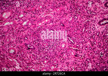 Renal tuberculosis, light micrograph, photo under microscope Stock Photo