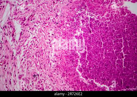 Renal tuberculosis, light micrograph, photo under microscope Stock Photo