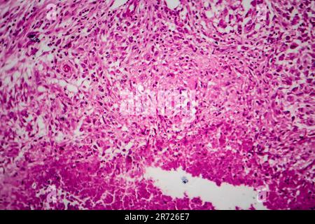 Renal tuberculosis, light micrograph, photo under microscope Stock Photo