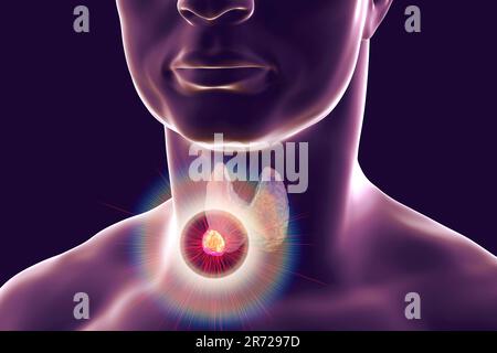Destruction of thyroid tumor, computer illustration. Conceptual image for thyroid nodules and cancer treatment. Stock Photo