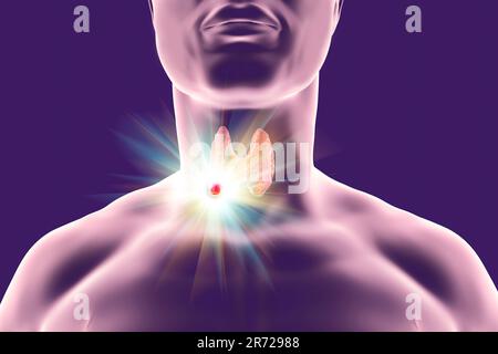 Destruction of thyroid tumor, computer illustration. Conceptual image for thyroid nodules and cancer treatment. Stock Photo