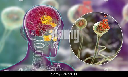 Rhinocerebral mucormycosis (or zygomycosis), a brain lesion and sinusitis caused by fungi Mucor, also known as black fungus, with close-up view of the Stock Photo