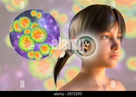 Otitis media ear infection caused by Streptococcus pyogenes bacteria, conceptual computer illustration. Acute otitis media is the inflammation of the Stock Photo