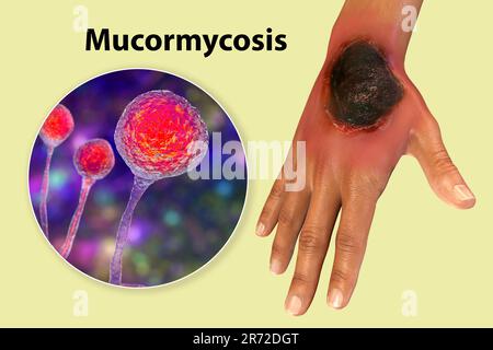 Cutaneous mucormycosis, a disease caused by Mucor fungi, computer artwork. Mucor mold is also known as black fungus, bread mold fungi. Mucor sp. fungi Stock Photo