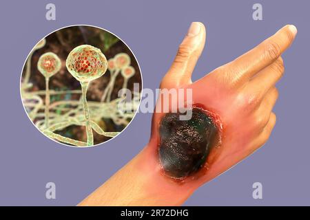 Cutaneous mucormycosis, a disease caused by Mucor fungi, computer artwork. Mucor mold is also known as black fungus, bread mold fungi. Mucor sp. fungi Stock Photo