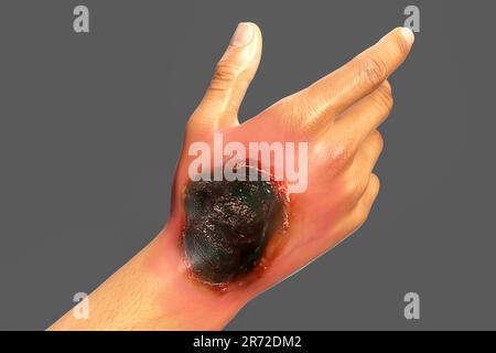 Cutaneous mucormycosis, a disease caused by Mucor fungi, computer artwork. Mucor mold is also known as black fungus, bread mold fungi. Mucor sp. fungi Stock Photo