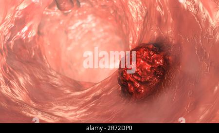 Computer illustration of a malignant (cancerous) tumour (red) in the colon. Risk factors for colorectal cancer are smoking, obesity and lack of physic Stock Photo